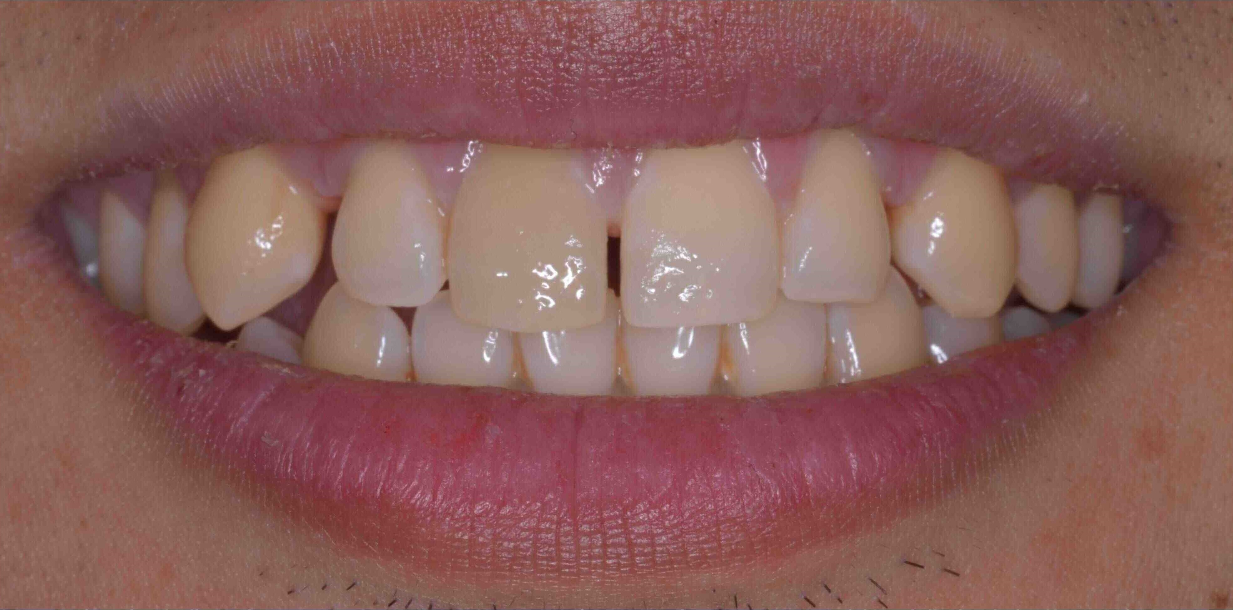 Invisalign and whitening transformation